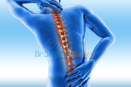 Homeopathic Medicine for Ankylosing Spondylitis Treatment