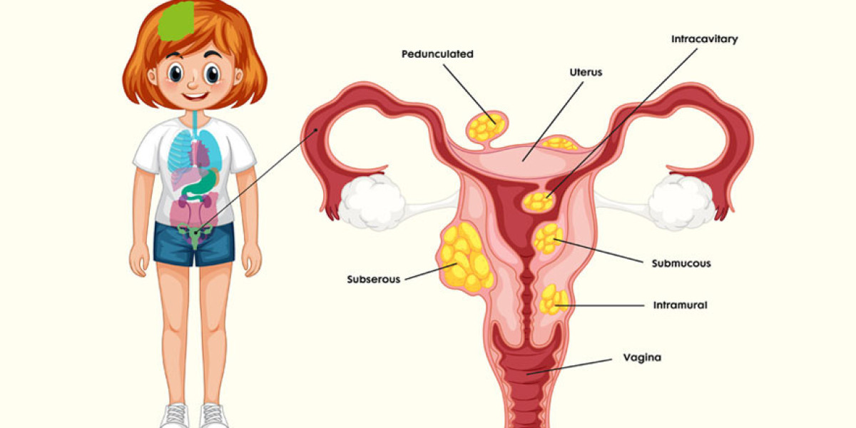 Comprehensive Uterine Fibroids Treatment Options by Flowcare