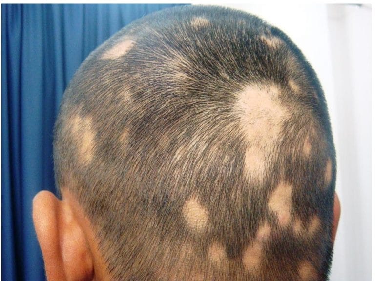 Get the Best Homeopathic Treatment for Hairfall in India