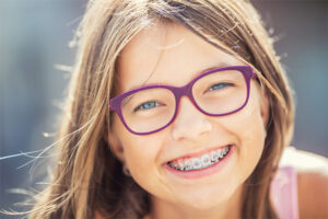 Dental Braces in Burleson | Damon Braces Dental Braces in Burleson | Damon Braces